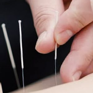 dry needling courses New Zealand